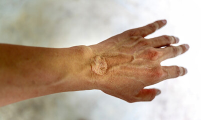 Close-up of scars on hands skin imperfections or defects caused by an accident scar healthcare concept