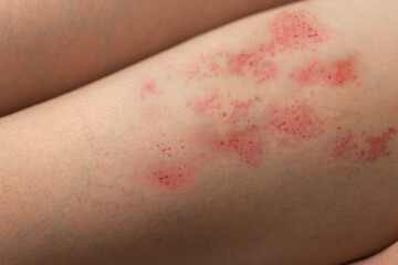 Painful shingles in woman