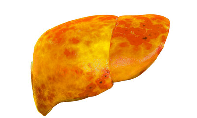Unhealthy liver, transparent background