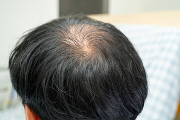 Bald in the middle head and begin no loss hair glabrous of mature Asian business smart active...