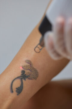 Young woman undergoing laser tattoo removal procedure in salon, closeup.