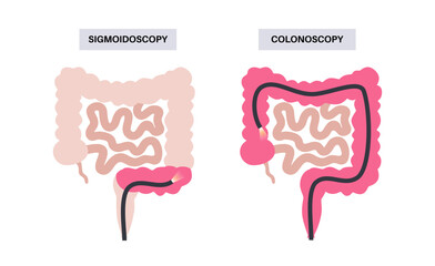 Colonoscopy and sigmoidoscopy