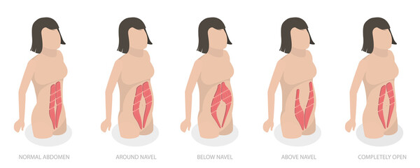 3D Isometric Flat  Conceptual Illustration of Abdominal Muscle Diastasis, Women Probmlem After Pregnancy