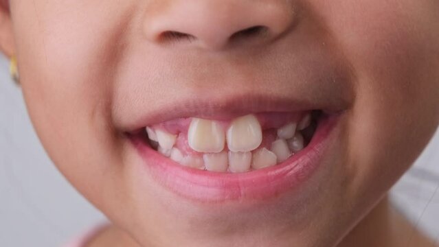 Close-up of cute young girl smiling wide, showing empty space with growing first front teeth. Little girl with big smile and missing milk teeth. Dental hygiene concept
