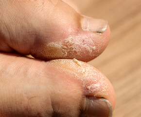 dry rough skin on toes as background.