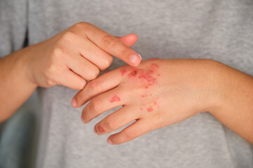 Patient hands applying ointment cream on eczema. Dermatitis, atopic skin.
