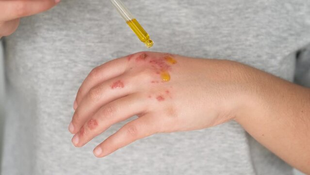 Patient hands applying rosehip oil on eczema. Dermatitis, atopic skin natural remedy.