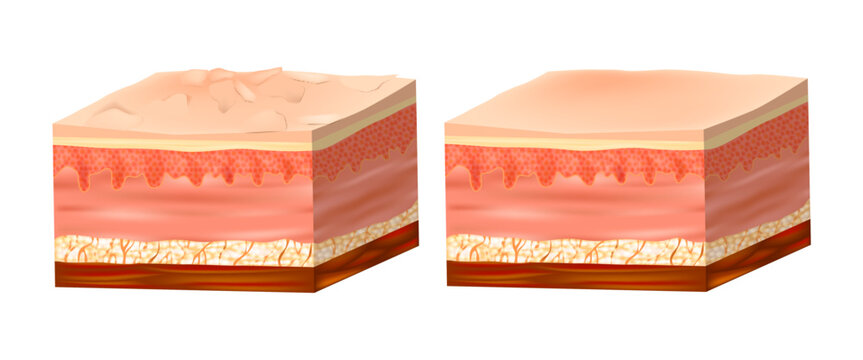 Dry and healthy skin texture. Infographic with Human skin layers diagram. Before and after skin moisturization. 