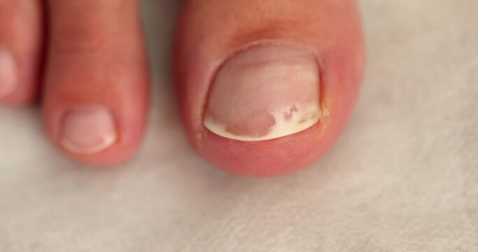 Fungal infection on toenail closeup 4k movie slow motion. Podology treatment of nail diseases concept