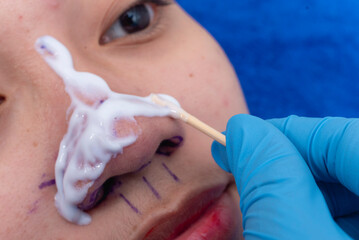Applying topical anesthesia via a cotton swab to the nose to numb the skin. Preoperative procedure for an open rhinoplasty procedure.