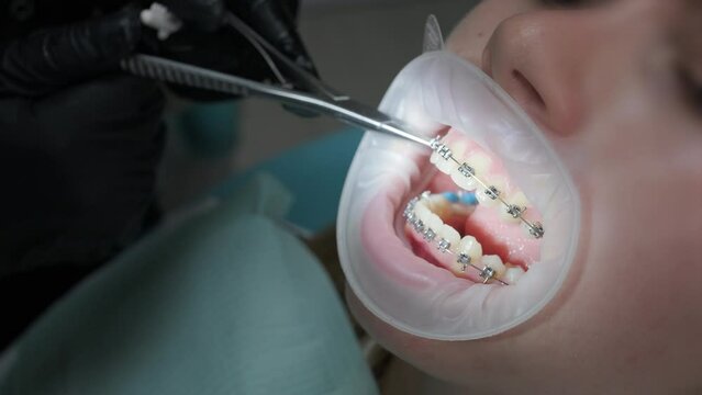 Close up of dentist hand using dental forceps while putting orthodontic braces on female patient teeth. Woman having dental procedure in clinic. Concept of dentistry and orthodontic treatment.