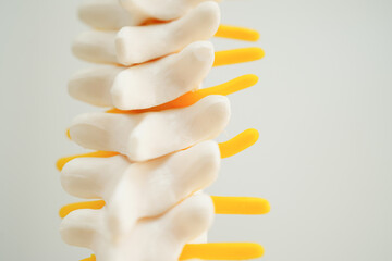 Spinal nerve and bone, Lumbar spine displaced herniated disc fragment, Model for treatment medical...