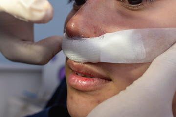 A cosmetic surgeon applies mustache dressing after nasal reconstruction surgery, septoplasty or...