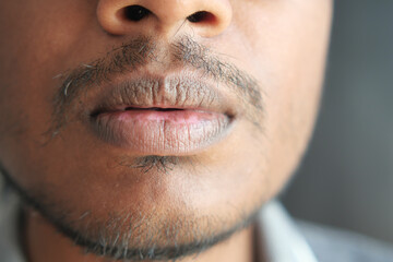 Close up of a young men hand dry lips 