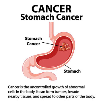 Illustrated Infographic: Stomach Cancer and Abnormal Cell Growth