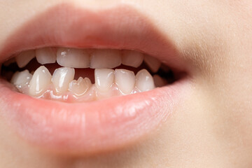 The teeth of a six-year-old child, a crookedly growing incisor in place of a lost milk tooth.