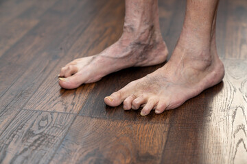 Man's deformed hammertoes showing left foot one year after surgery showing multiple conditions including toenail fungus and phlebitis.