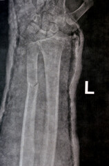 Plain X ray of right forearm (mistakenly written Left on the film) showing fracture of the lower...
