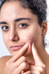 Naklejka premium Acne on the young girl's face. Acne in teenage girl