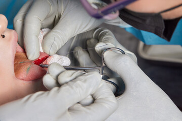 tongue splitting. cutting the tongue, one type of modification of the human body. surgery concept.