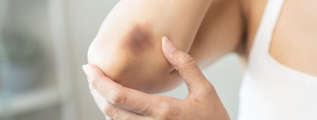 Close up of stain bruise wound on her elbow, contusion asian young woman an accident fell down...