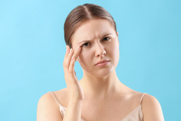 Upset teenage girl with acne problem on blue background, closeup