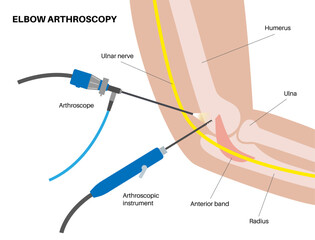 Obraz premium Elbow arthroscopy surgery