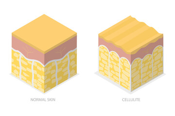 3D Isometric Flat  Conceptual Illustration of Cellulite Skin, Womans Beauty and Skicare - obrazy, fototapety, plakaty