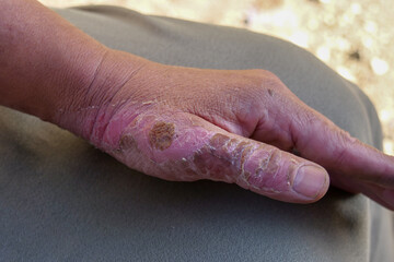 Pink skin on thumb and hand recovering healing and pealing after being burned with steam