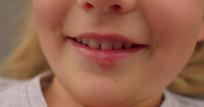 Herpes virus on the lips of a little beautiful girl