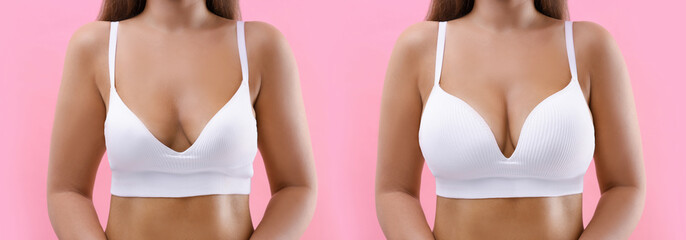 Woman before and after breast augmentation on pink background, closeup. Collage with photos showing...