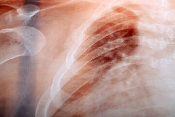 X-Ray Image Of Human Chest for a medical diagnosis