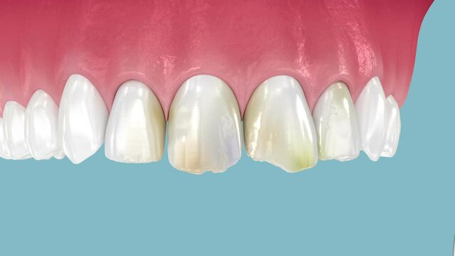 Dental veneers placement over teeth and happy smile at the end. 3D animation