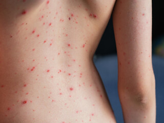 Persons back with chickenpox (varicella) blisters on his skin.
