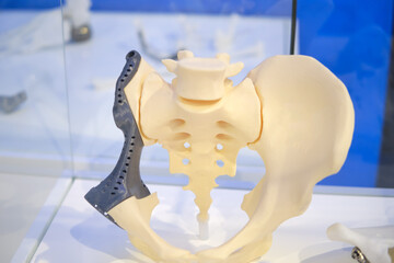 The artificial limb for the pelvic bone disability allows the amputee adult to participate in...