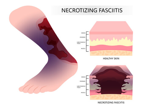 Diabetic foot and Bacteria infection on the skin cancer with Necrotizing fasciitis of leg cause limb pain fat scab in medical care