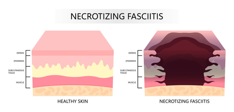 Epidermis layer of the skin with bacteria Necrotizing fasciitis infection cause pain limb leg with scab fat cancer care in medical