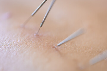 Dry needling acupuncture needles on patient, close up.