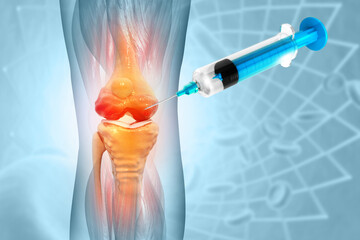 Anatomy Human Knee Joint Treatment, Osteoarthritis Injection, Drug Method Injection, knee injury, 3d illustration - obrazy, fototapety, plakaty
