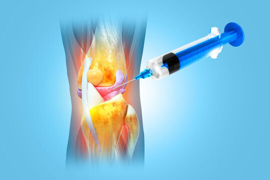 Anatomy Human Knee Joint Treatment, Osteoarthritis Injection, Drug Method Injection, knee injury, 3d illustration