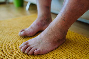 A close-up shot of man's feet with diabetic foot complications. - obrazy, fototapety, plakaty