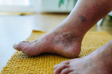 A close-up shot of man's feet with diabetic foot complications.