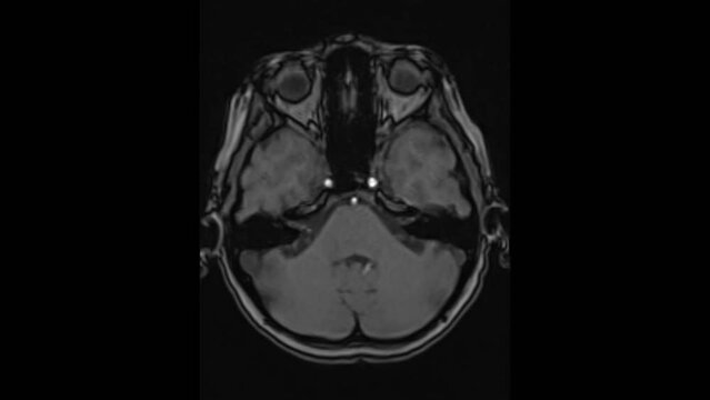 Magnetic resonance imaging of the brain. MRI of the brain. Medical examination of the human brain