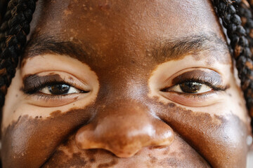 Close-up view shot of young adult african woman eyes with vitiligo skin. Diversity and people concept