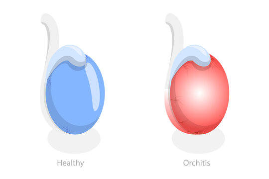 3D Isometric Flat  Conceptual Illustration of Orchitis, Inflammation of Testes