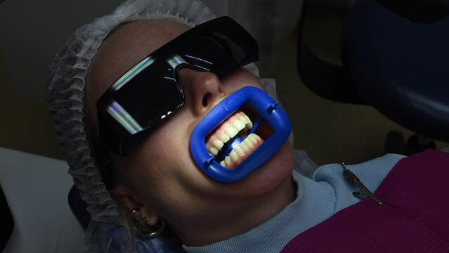 Dental Whitening process in patient mouth. Teeth whitening with UF Lamp, Led Lamp and gel. Dental Extreme Close up Macro Video. Concept of professional dental hygiene. 4k 120 fps slow motion footage