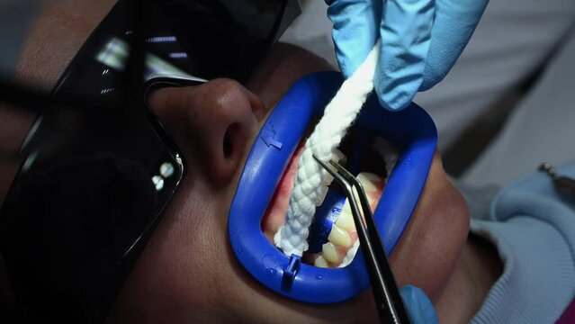 Dental Whitening process in patient mouth. Teeth whitening with UF Lamp, Led Lamp and gel. Dental Extreme Close up Macro Video. Concept of professional dental hygiene. 4k 120 fps slow motion footage