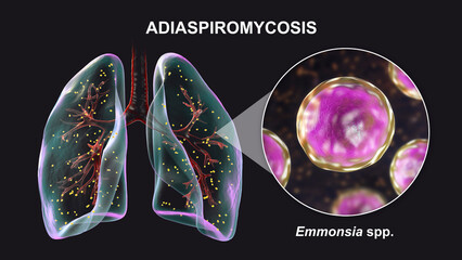Lung adiaspiromycosis and close-up view of Emmonsia fungi, 3D illustration