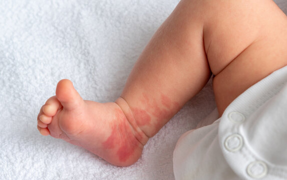 Hemangioma red birthmark on the leg of newborn baby