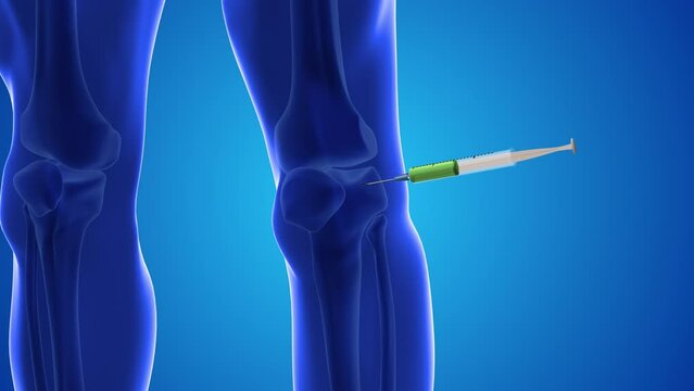 Injecting stem cells into a human knee.
